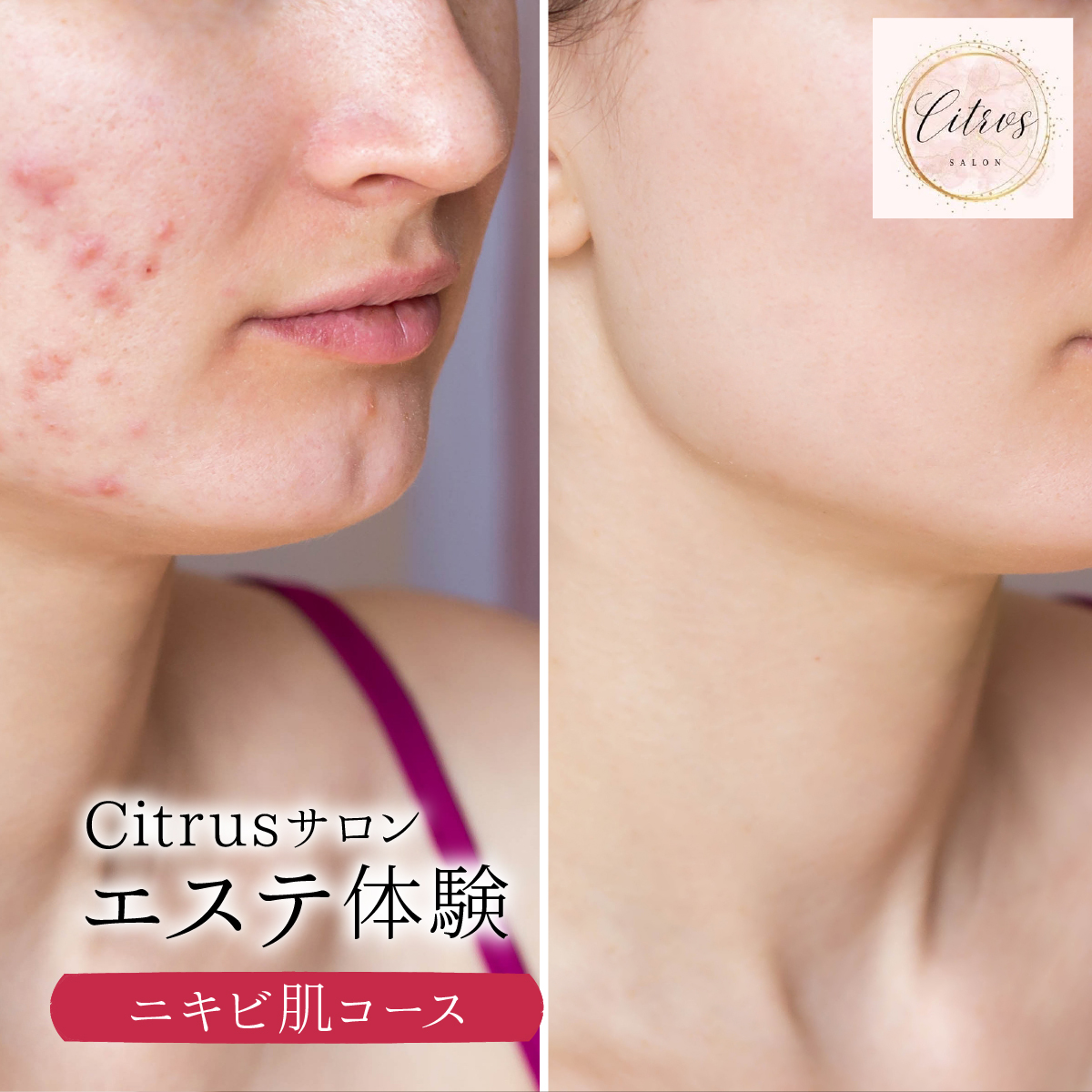 ニキビ肌コース（陶肌トリートメント＋ビタミンC〈VCF〉） 240P8003